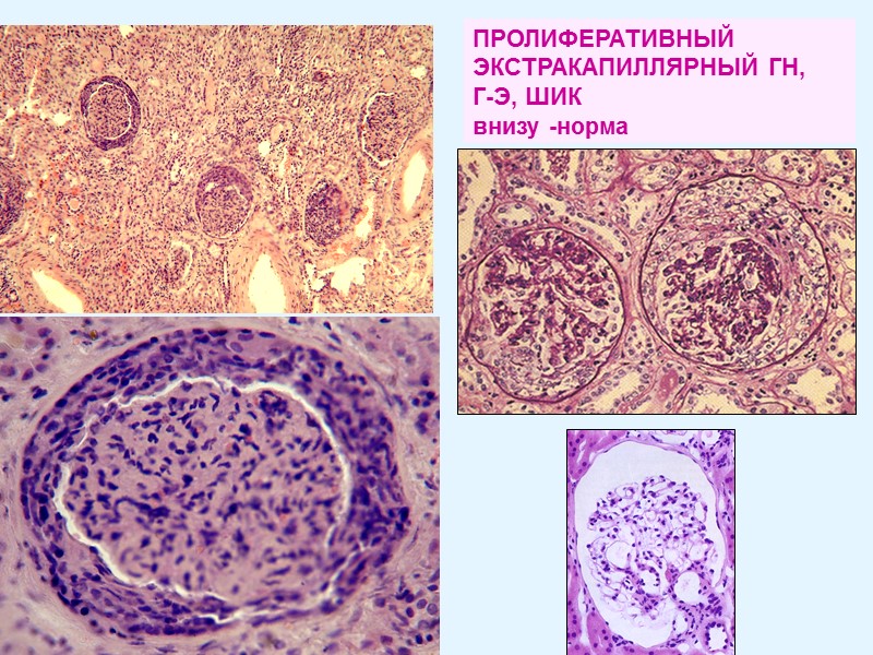 ПРОЛИФЕРАТИВНЫЙ ЭКСТРАКАПИЛЛЯРНЫЙ ГН,  Г-Э, ШИК внизу -норма